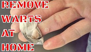 Image result for Wart Removal On Leg