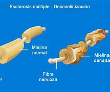 Image result for escler�sico