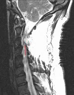 Image result for Mr Spine Cervical without Contrast