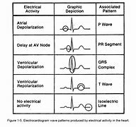 Image result for Normal Heart Rhythm EKG
