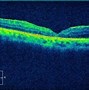 Image result for Macular Hole OCT Scan