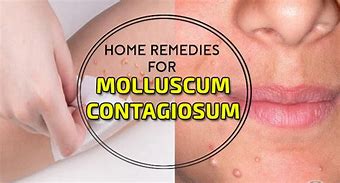 Image result for ZymaDerm Molluscum Treatment