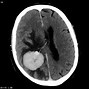 Image result for Papilloma Tumor