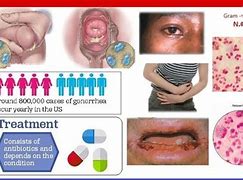 Image result for Gonorrhea Signs and Symptoms