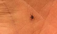 Image result for What Does a Tick Look Like Under Skin