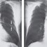 Image result for Show Me a Cat Scan of Lung Nodules