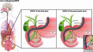 Image result for ercp