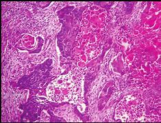 Image result for Squamous Cell Carcinoma Lung Cancer