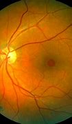 Image result for Hole in Retina