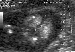 Image result for Craniosynostosis Fetal Ultrasound