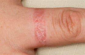 Image result for Contact Dermatitis