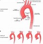Image result for Aortic Sinus