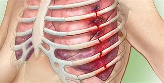 Image result for Broken Ribs Pictures