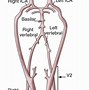Image result for Vertebral Artery Ultrasound