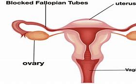 Image result for Blocked Fallopian Tube Symptoms