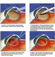 Image result for Eye Surgery