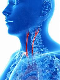 Image result for Extracranial Carotid