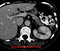 Image result for aortitis