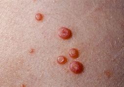 Image result for Molluscum Bumps Removal