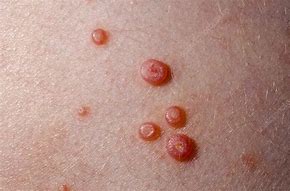 Image result for Cutaneous Nodules