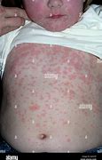 Image result for Amoxicillin Allergy Rash