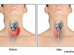 Image result for Thyroid Surgery Before and After