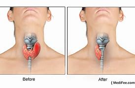 Image result for Thyroid Surgery