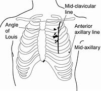 Image result for Thoravent Pneumothorax