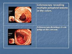 Image result for Colon Polyps Colonoscopy