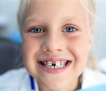 Image result for Braces with Missing Teeth