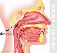 Image result for adenoidel