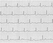 Image result for Degrees of Heart Block