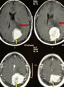 Image result for Cat Scan Benign Brain Tumor