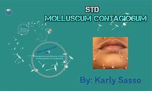 Image result for Molluscum Contagiosum Stages Pictures
