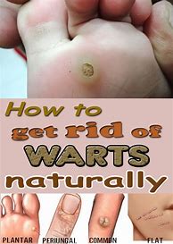 Image result for How to Get Rid of Warts in a Week