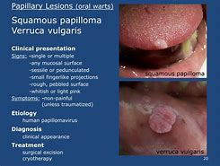 Image result for Verruca Vulgaris Mouth