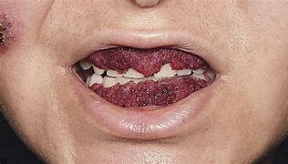 Image result for Calcified Plaque Teeth