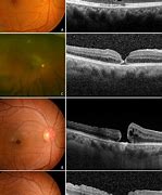 Image result for Retina Hole Progression