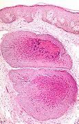 Image result for Musculosum Contagiosum
