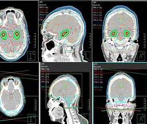 Image result for Whole Brain Radiation