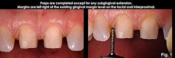 Image result for Subgingival Margin