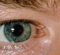 Image result for Wart On Inside of Eyelid