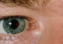 Image result for Warts On Eyes