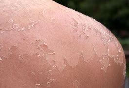 Image result for SunBurn Skin Peel