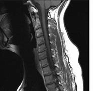Image result for Cervical Spine Disc