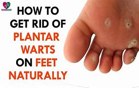 Image result for How to Get Rid of Foot Warts