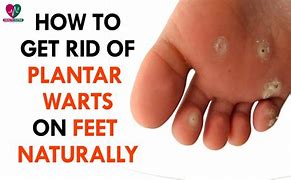Image result for How to Get Rid of Warts On Feet