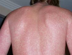 Image result for Sun Burn Rash/Bumps Pictures