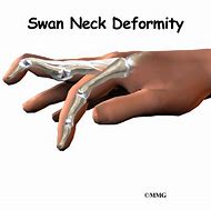 Image result for Swan Hand Funtional Figure 8 Ring