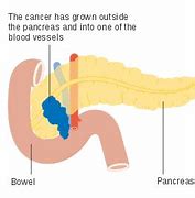 Image result for Pancreatic Cancer
